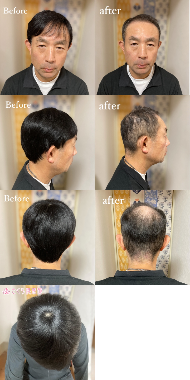 メンズフルウィッグ 男性用 全かつら 人毛100％ 機械植え製 軽量 MM300装着画像各種